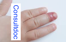 Paronychia Nail Infection