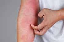 Eczema