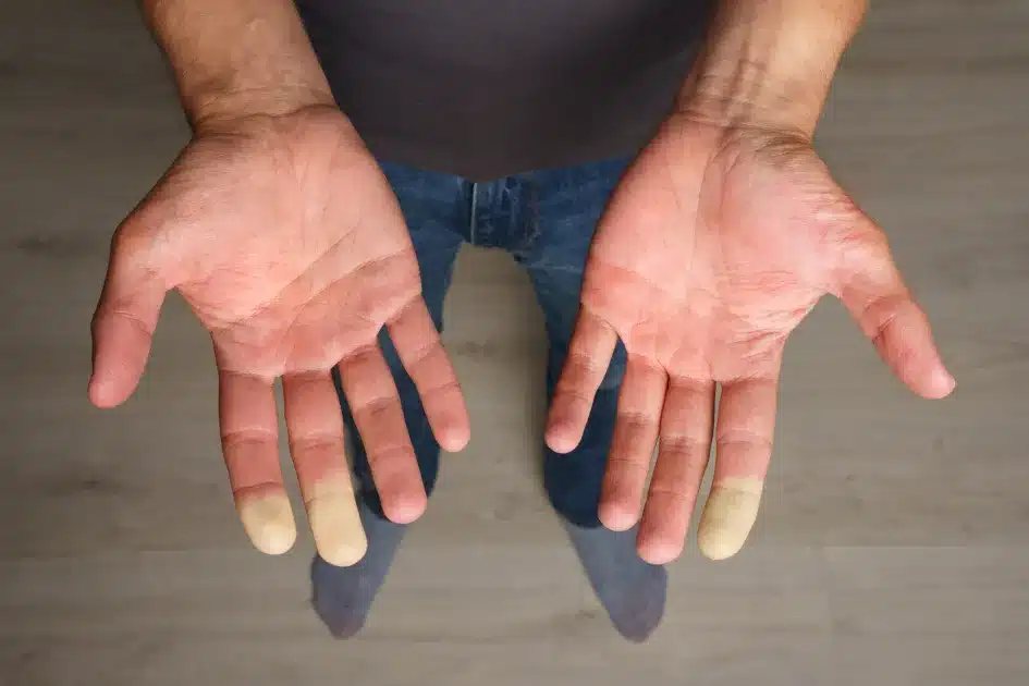 How We Can Cure Raynaud's Phenomenon Easily